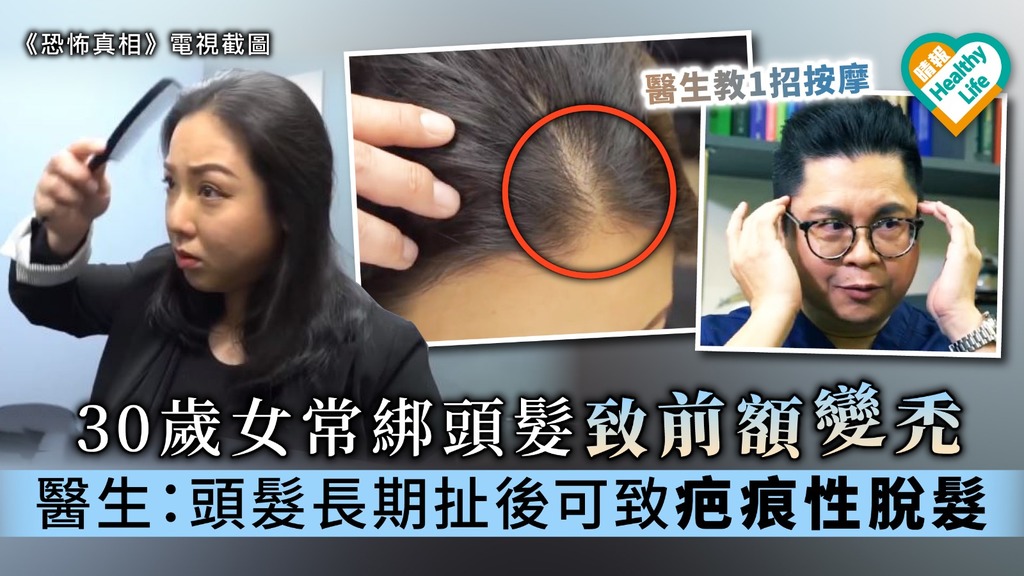 【恐怖真相】30歲女常束頭髮致前額變禿 醫生：頭髮長期扯後可致疤痕性脫髮【附護髮貼士】