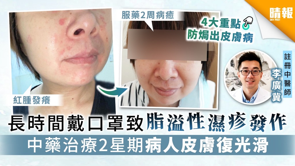 【皮膚病】長時間戴口罩致脂溢性濕疹發作 中藥治療2星期病人皮膚復光滑