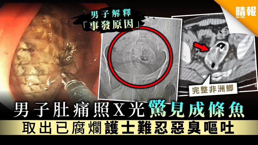 【奇人奇事】男子肚痛照X光驚見成條魚 取出已腐爛護士難忍惡臭嘔吐