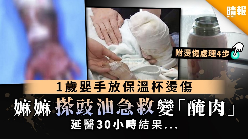 【民間療法】1歲嬰手放保溫杯燙傷 嫲嫲搽豉油急救變「醃肉」 延醫30小時結果...【附燙傷處理4步】