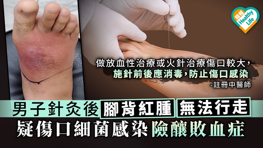 男子針灸後腳背紅腫無法行走 疑傷口細菌感染險釀敗血症