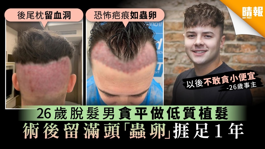 【植髮手術】26歲脫髮男貪平做低質植髮 術後留滿頭「蟲卵」捱足1年