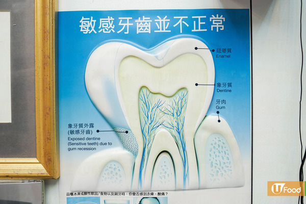 第四、象牙質外露。部分病人洗牙後牙齒都呈黃色，很多時候是因為牙齒的琺瑯質，經過長時間磨損後變薄了，使下面黃色的的象牙質外露，看上去的牙齒比一般人的黃。