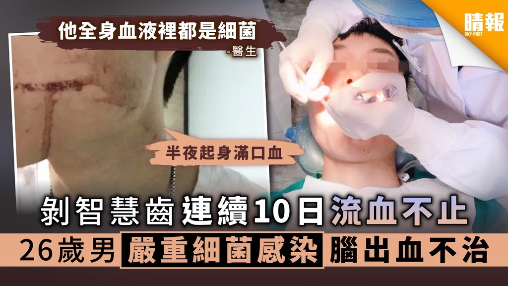 【拔智慧齒】剝智慧齒連續10日流血不止 26歲男嚴重細菌感染腦出血不治