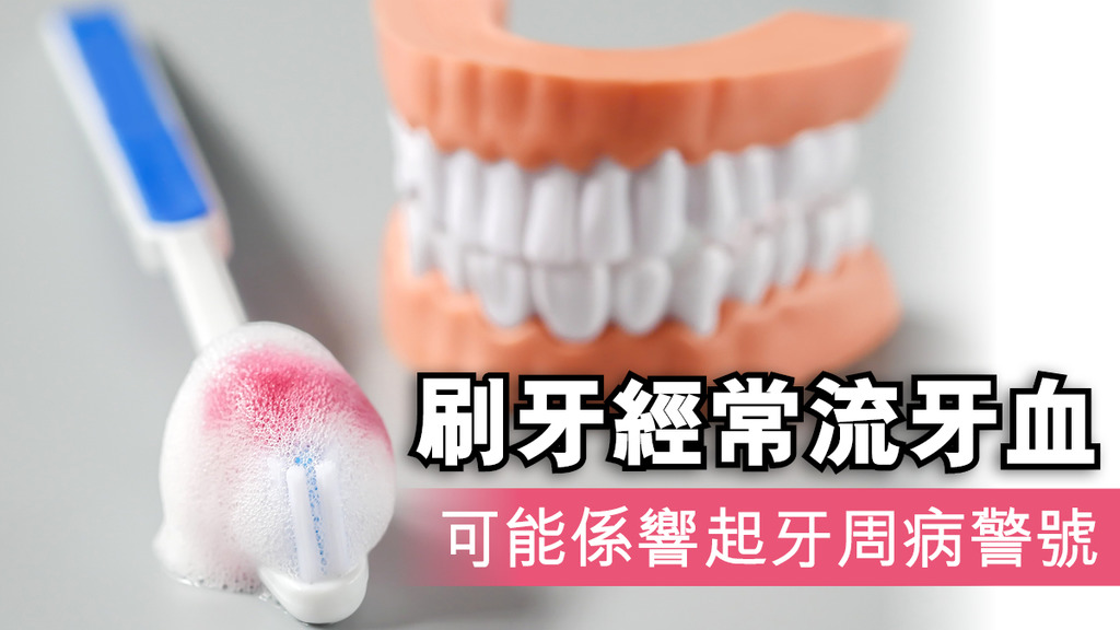 刷牙經常流牙血 可能係響起牙周病警號