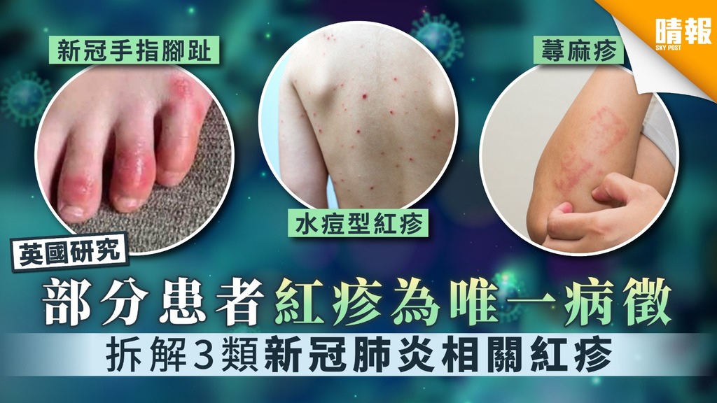 【新冠肺炎．英國研究】部分患者紅疹為唯一病徵 拆解3類新冠肺炎相關紅疹