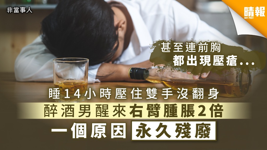 【 酒醉意外】醉酒男睡14小時壓住雙手沒翻身 醒來右臂腫脹2倍一個原因永久殘廢【附醫生拆解】