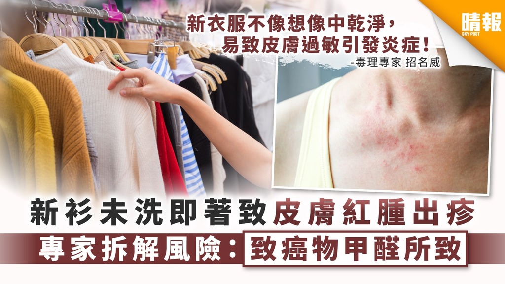 【新衫致敏】新衫未洗即著致皮膚紅腫出疹 專家拆解風險：致癌物甲醛所致