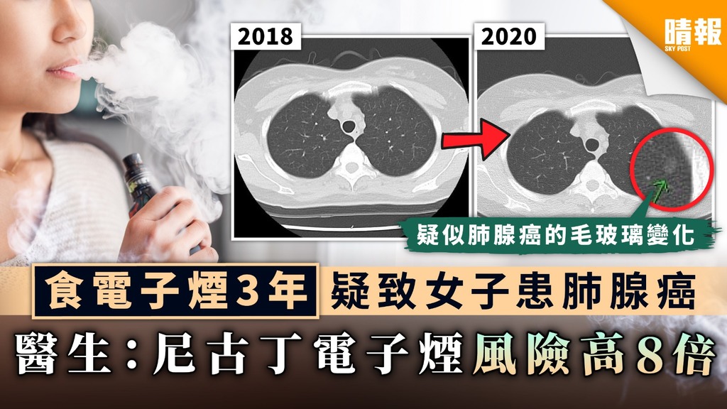 【肺腺癌】食電子煙3年疑致女子患肺腺癌 醫生：尼古丁電子煙風險高8倍