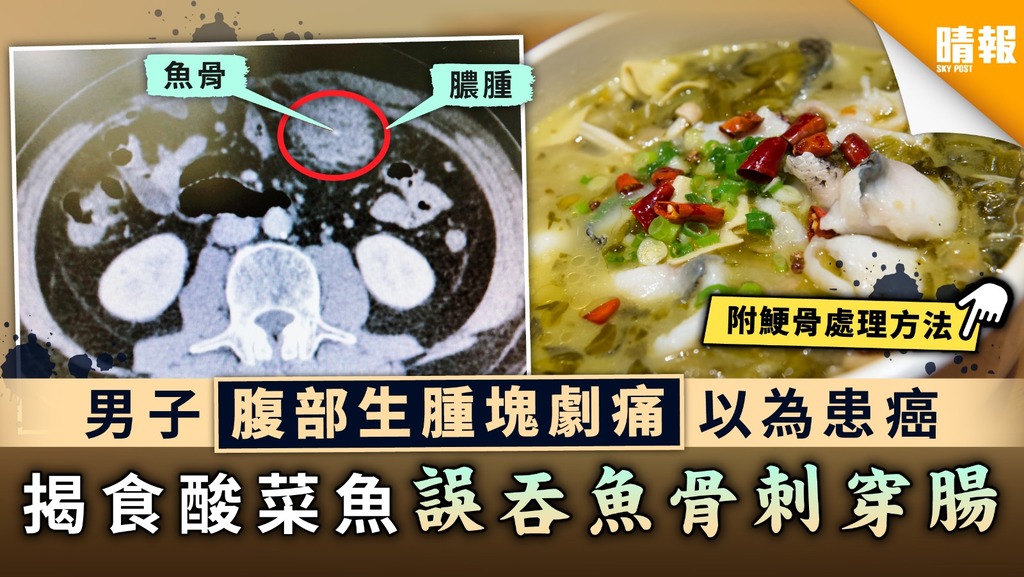 【食用安全】男子腹部生腫塊劇痛以為患癌 揭食酸菜魚誤吞魚骨刺穿腸【附鯁骨處理方法】