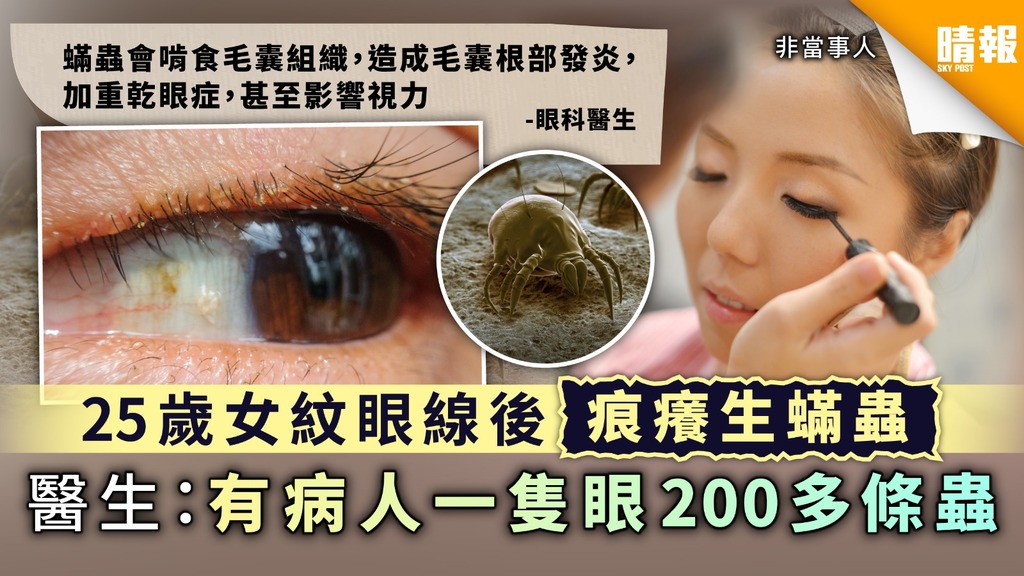 蟎蟲入侵｜25歲女紋眼線後痕癢生蟎蟲 醫生：有病人一隻眼200多條蟲