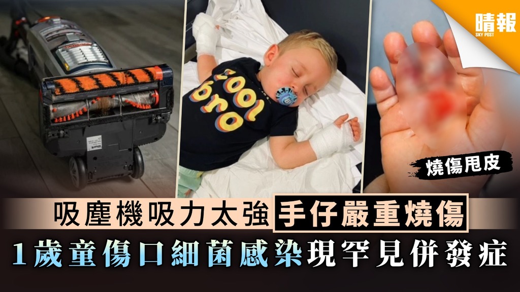家居意外︳吸塵機吸力太強手仔嚴重燒傷 1歲童傷口細菌感染現罕見併發症