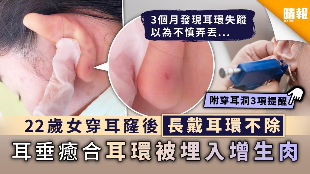 穿耳洞｜22歲女穿耳窿後長戴耳環不除 耳垂癒合耳環被埋入增生肉【附穿耳洞3項提醒】