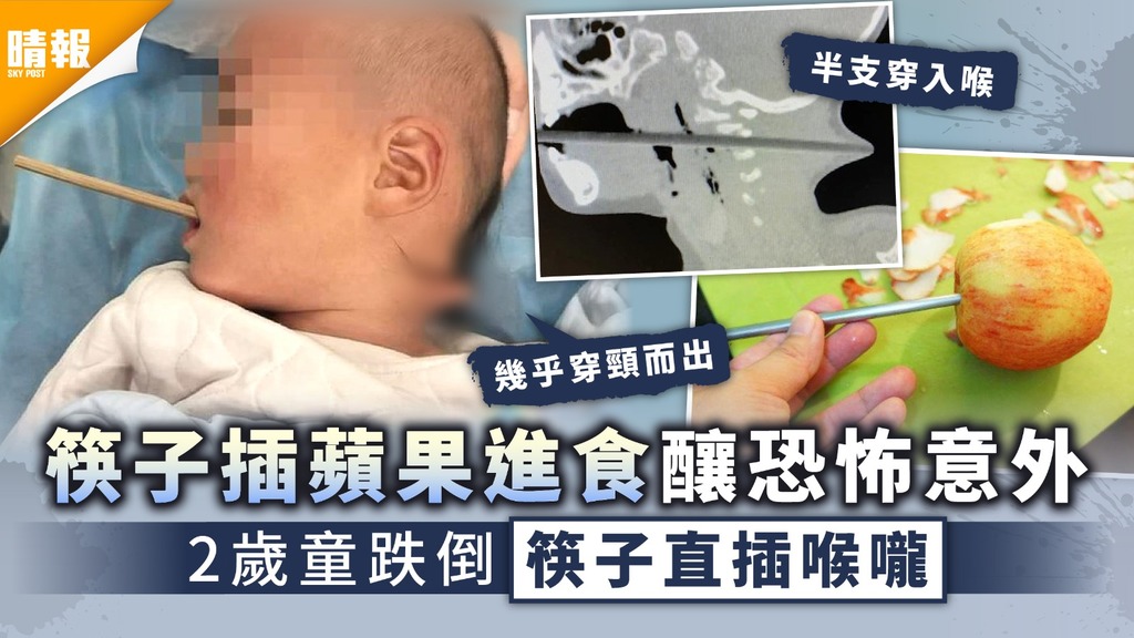 家長注意︳筷子插蘋果進食釀恐怖意外 2歲童跌倒筷子直插喉嚨