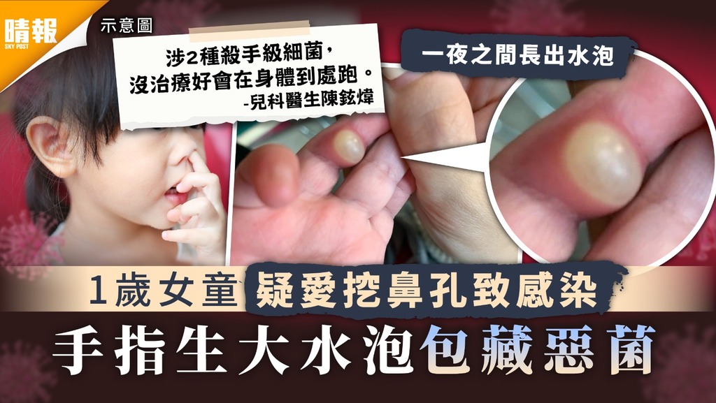 兒童健康｜1歲女童疑愛挖鼻孔致感染 手指生大水泡包藏惡菌