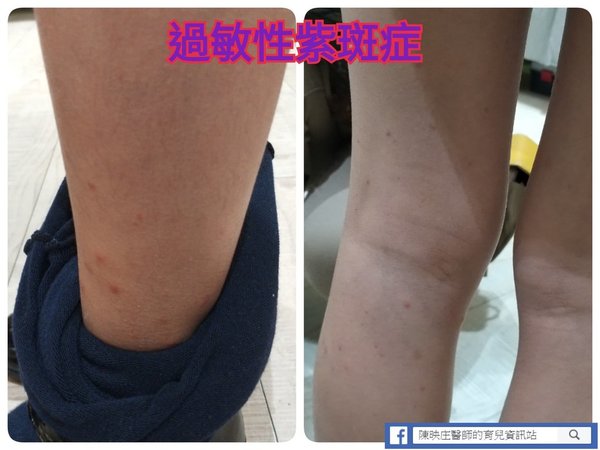 過敏性紫斑症 8歲女小腿現紫紅斑患兒科風濕病兒科醫生警告 嚴重可致腎衰竭 晴報 健康 兒科百問 D1225