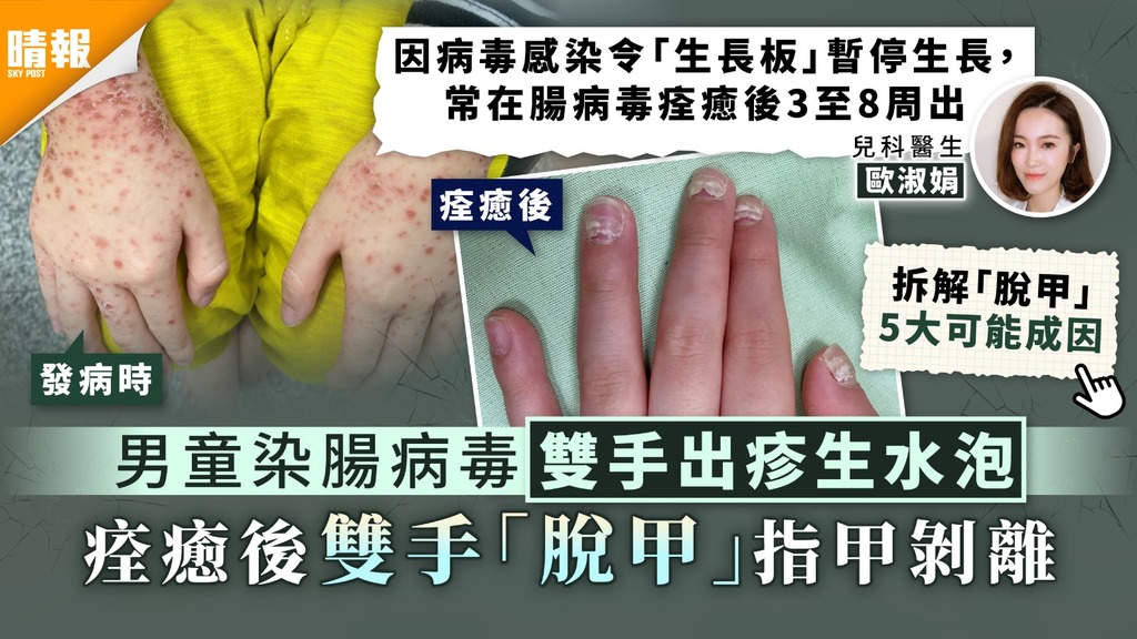手足口病 | 男童染腸病毒雙手出疹生水泡 痊癒後雙手「脫甲」指甲剝離