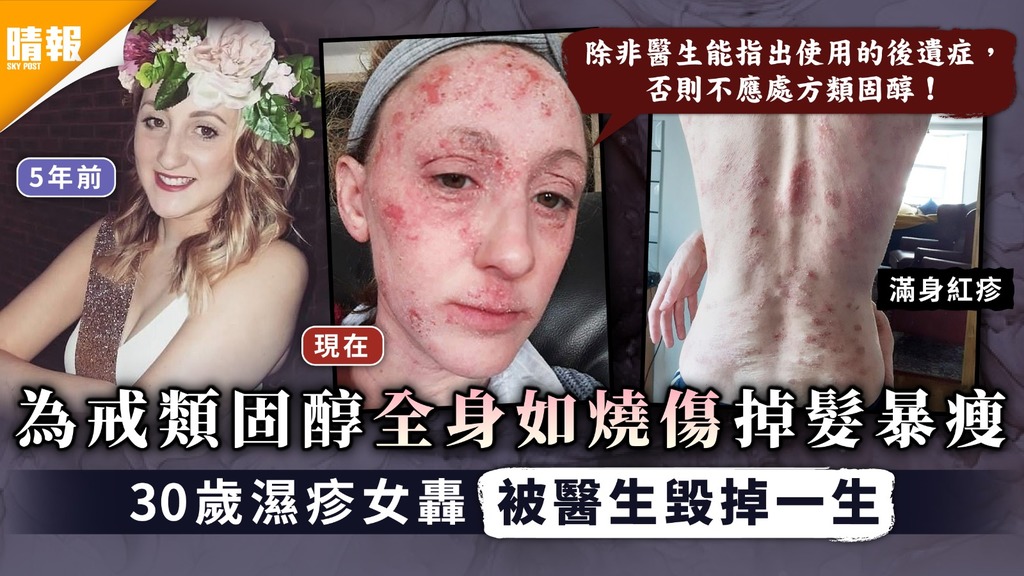 類固醇上癮| 為戒類固醇全身如燒傷掉髮暴瘦 30歲濕疹女轟被醫生毀掉一生