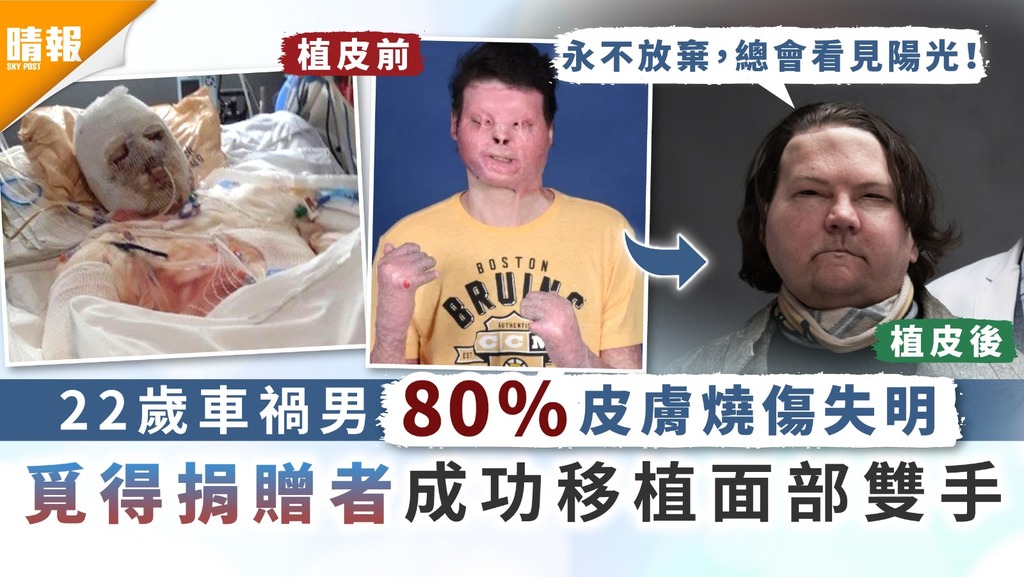 全球首例｜22歲車禍男80%皮膚燒傷失明 覓得捐贈者成功移植面部雙手