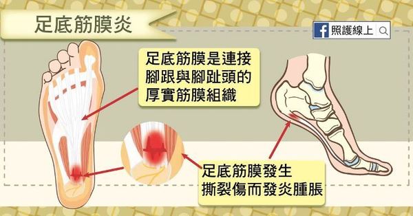 足底筋膜炎 | 長時間站立腳跟易疼痛發炎 拆解足底筋膜炎8大症狀+改善方法
