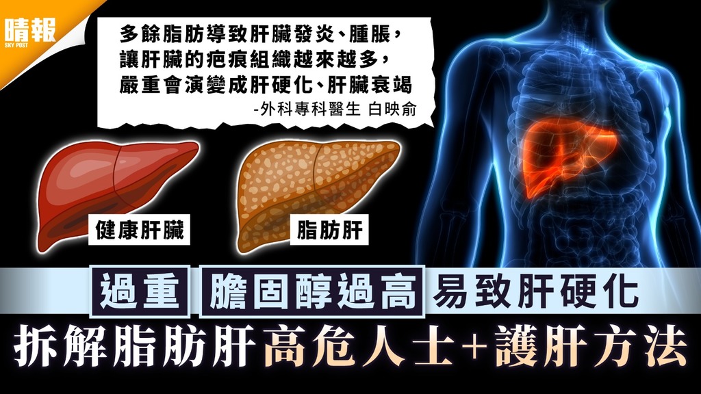 脂肪肝｜過重、膽固醇過高易致肝硬化 拆解脂肪肝高危人士+護肝方法
