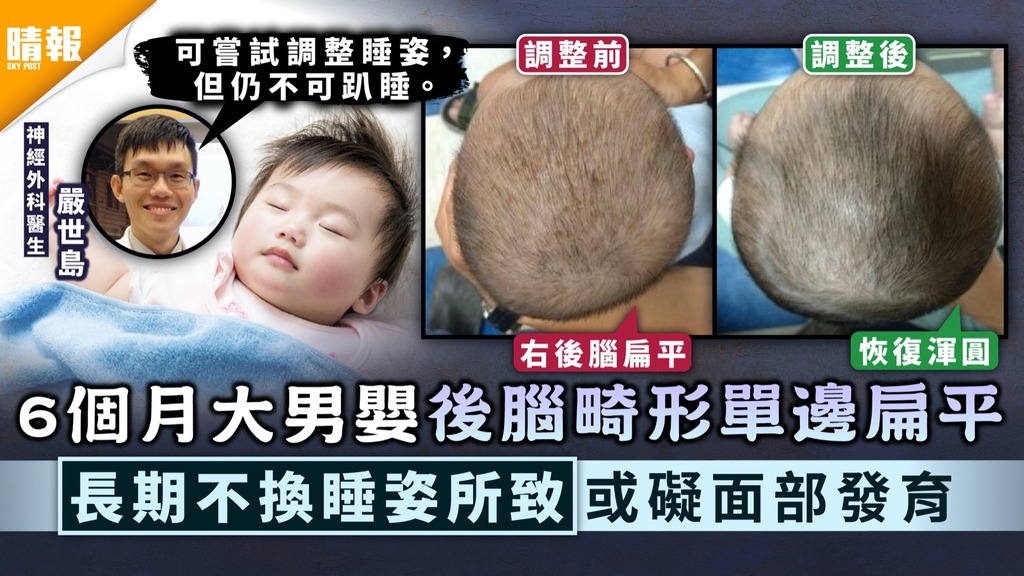 幼兒健康｜6個月大男嬰後腦畸形單邊扁平 長期不換睡姿所致或礙面部發育