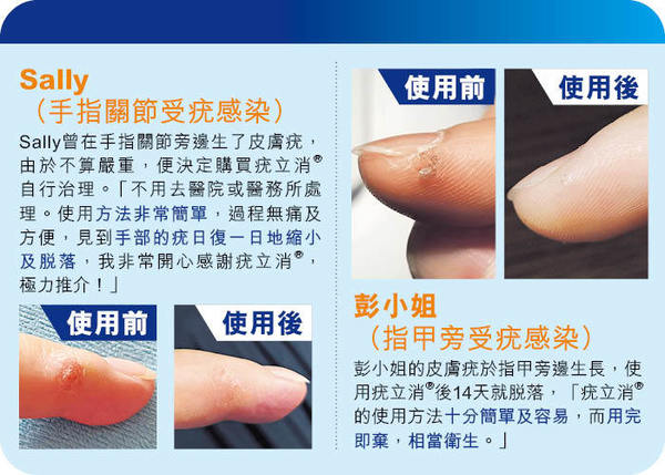 小心「疣」傳染！疣立消®冷凍除疣不求人讓你安在家中輕鬆除疣- 晴報- 健康- 皮膚護理- D210618