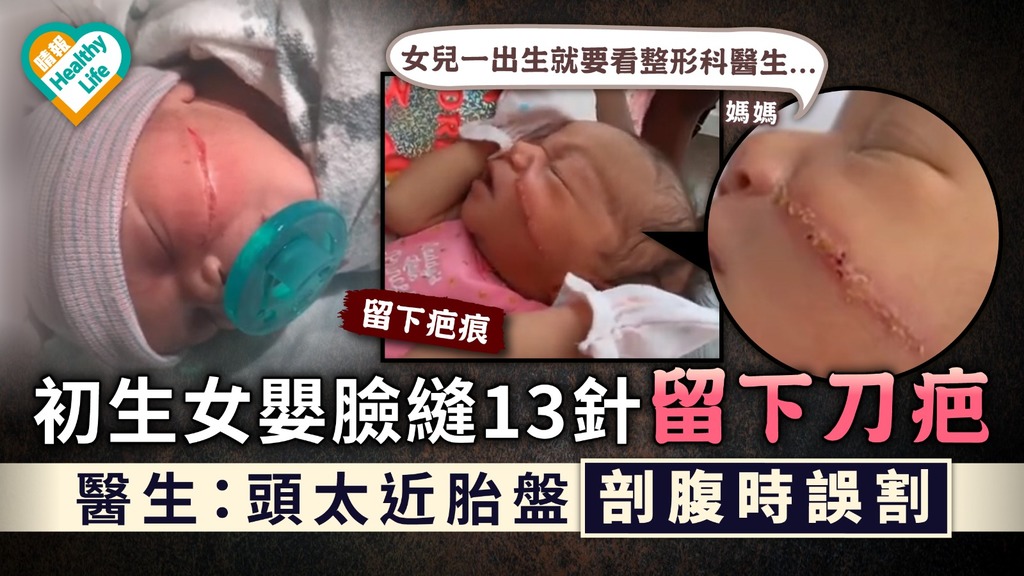醫療事故｜初生女嬰臉縫13針留下刀疤 醫生：頭太近胎盤剖腹時誤割