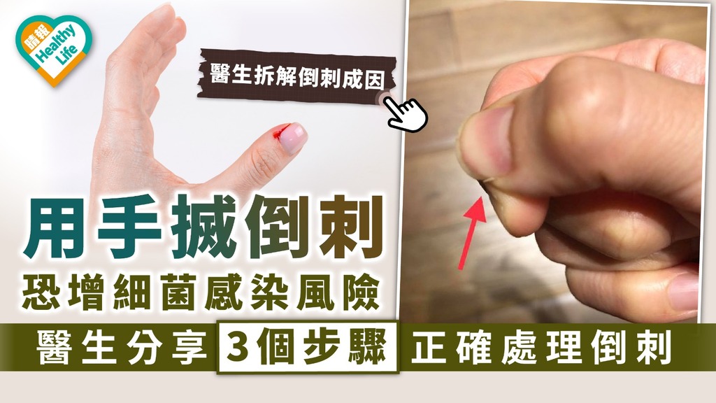 皮膚護理｜用手搣倒刺恐增細菌感染風險 醫生分享3個步驟正確處理倒刺