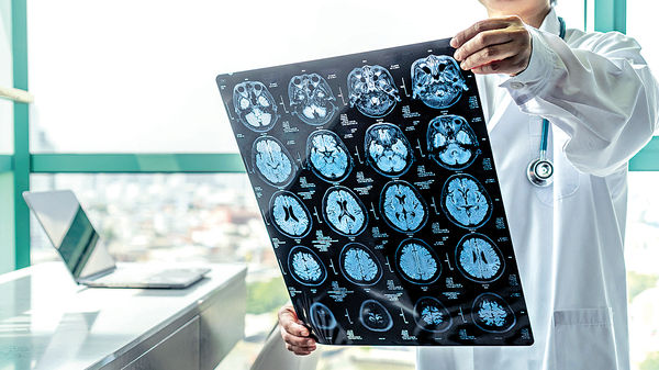 10分鐘完成分析MRI影像 AI辨識認知障礙 靈敏度逾9成