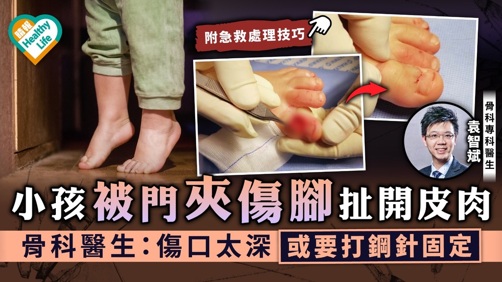家長注意｜小孩被門夾傷腳扯開皮肉 骨科醫生：傷口太深或要打鋼針固定