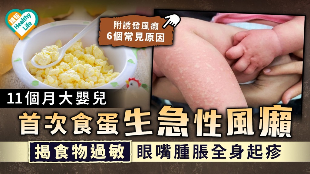 蕁麻疹｜11個月大嬰兒首次食蛋生急性風癩 揭食物過敏眼嘴腫脹全身起疹｜附誘發風癩6大原因