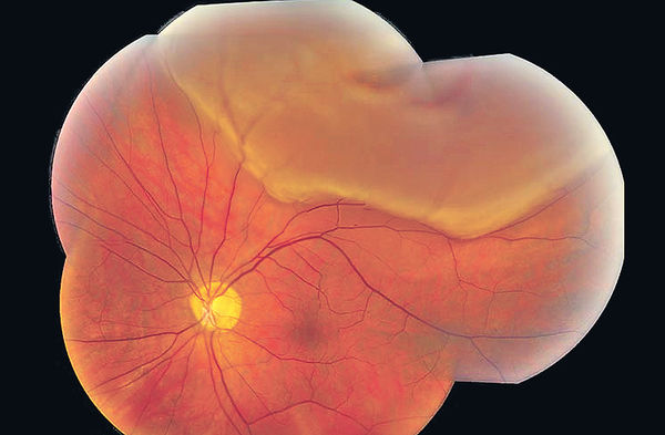 視網膜脫落認知誤區