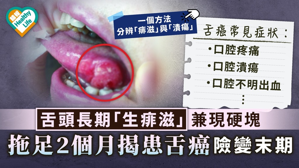 舌癌｜舌頭長期「生痱滋」兼現硬塊 拖足2個月揭患舌癌險變末期
