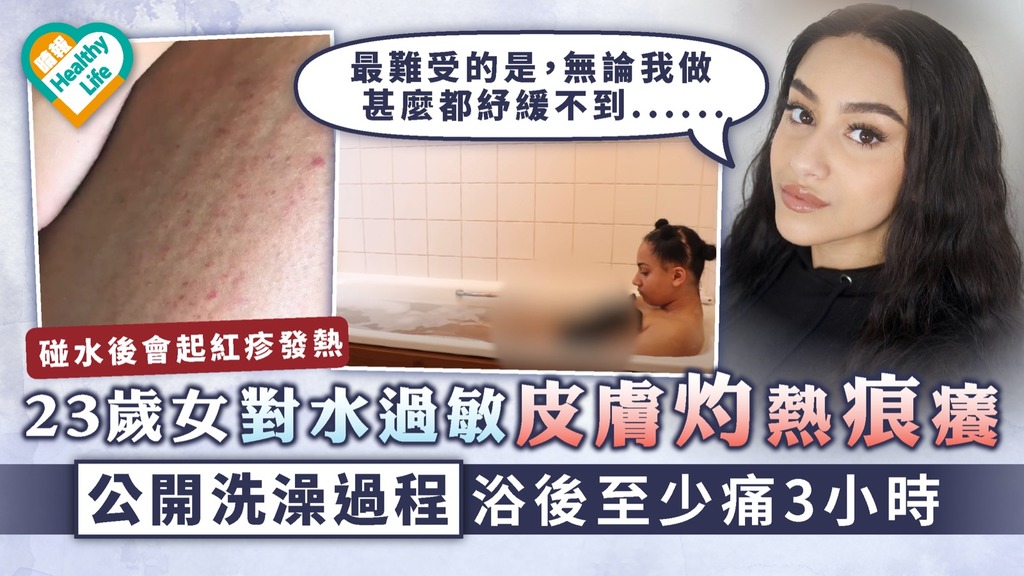 水源性瘙癢症｜23歲女對水過敏皮膚灼熱痕癢 公開洗澡過程浴後至少痛3小時