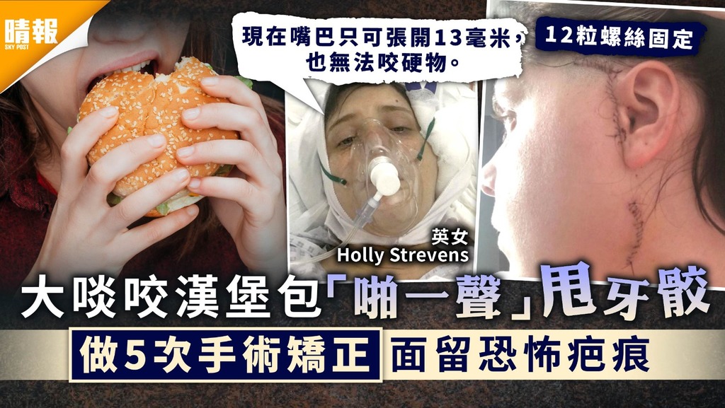 下顎脫骹｜大啖咬漢堡包「啪一聲」甩牙骹 做5次手術矯正面留恐怖疤痕
