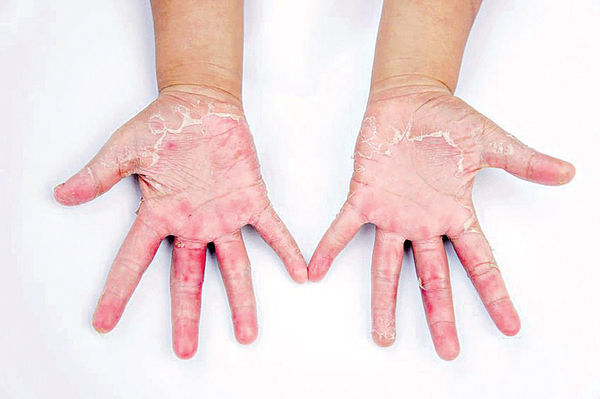 接觸性皮炎令皮膚痕腫 皆因酒精洗手？