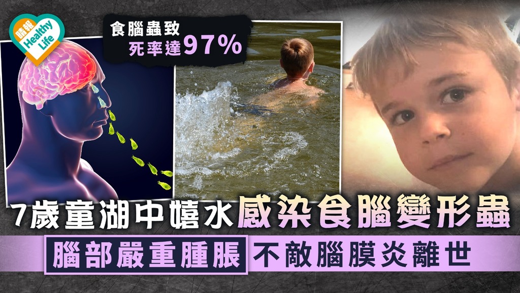 致命寄生蟲｜7歲童湖中嬉水感染食腦變形蟲 腦部嚴重腫脹終不敵腦膜炎離世｜附感染4大病徵