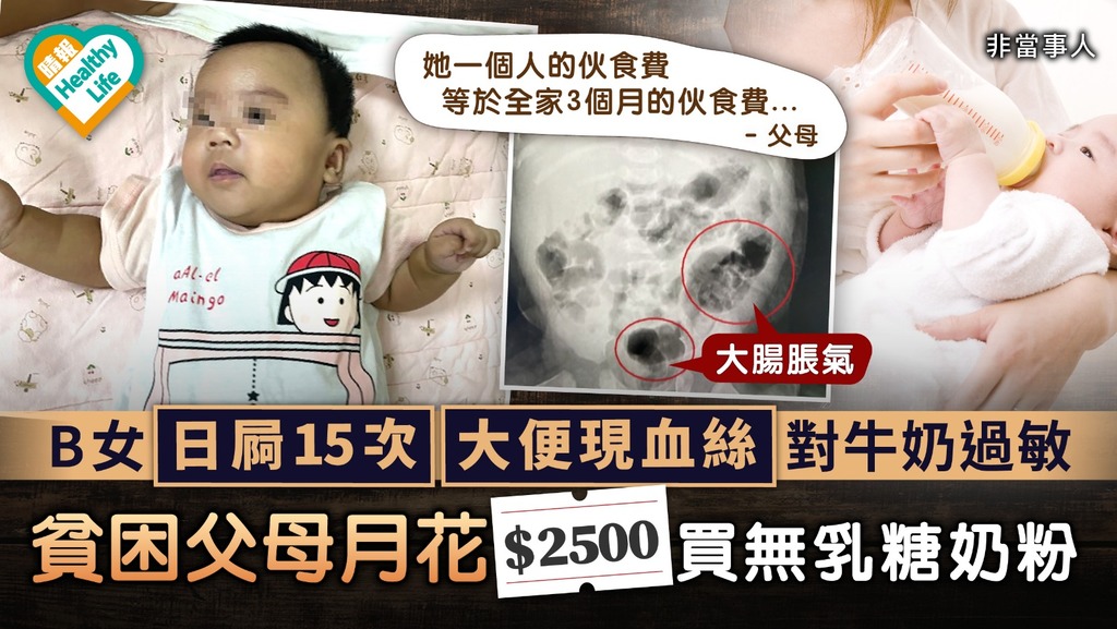 食物過敏｜B女日屙15次大便現血絲對牛奶過敏 貧困父母月花$2500買無乳糖奶粉