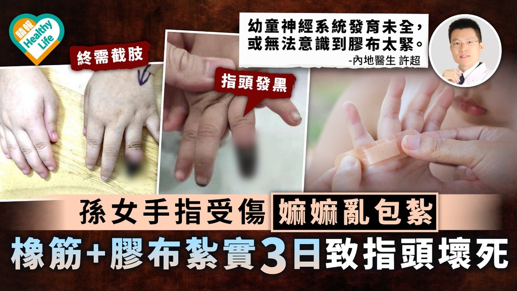 兒童健康｜孫女手指受傷嫲嫲亂包紮 橡筋+膠布紮實3日致指頭壞死