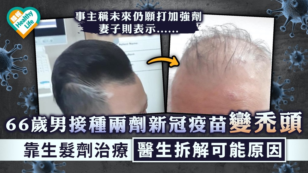 新冠疫苗｜66歲男接種兩劑新冠疫苗變禿頭 靠生髮劑治療醫生拆解可能原因｜附疫苗副作用一覽