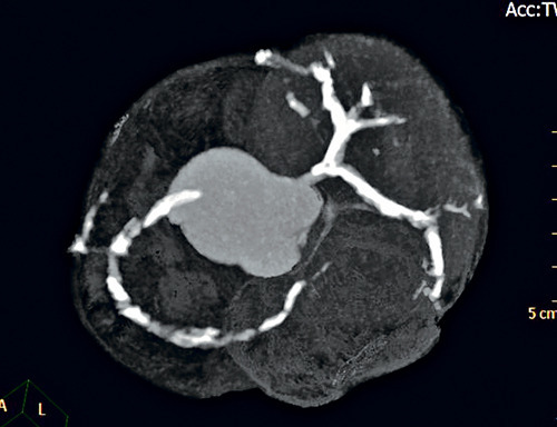 拒絕血管「石化」 由控糖護心開始