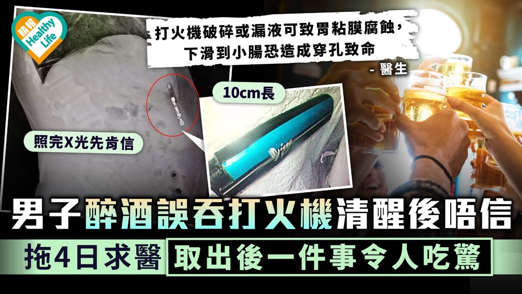 酒後失控｜男子醉酒誤吞打火機清醒後唔信 拖4日求醫取出後一件事令人吃驚