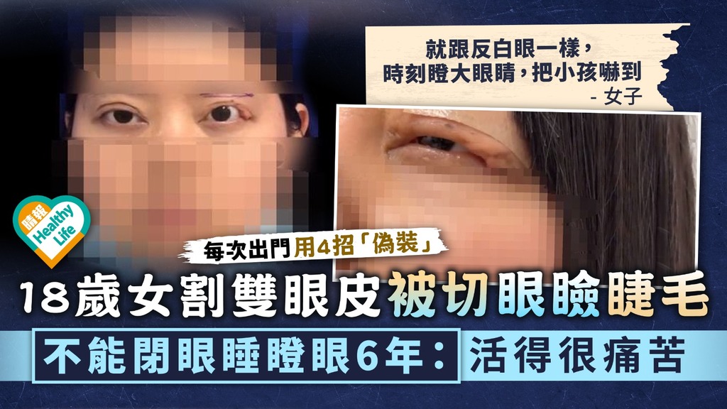 整容失敗︳18歲女割雙眼皮被切眼瞼睫毛 不能閉眼睡瞪眼6年：活得很痛苦