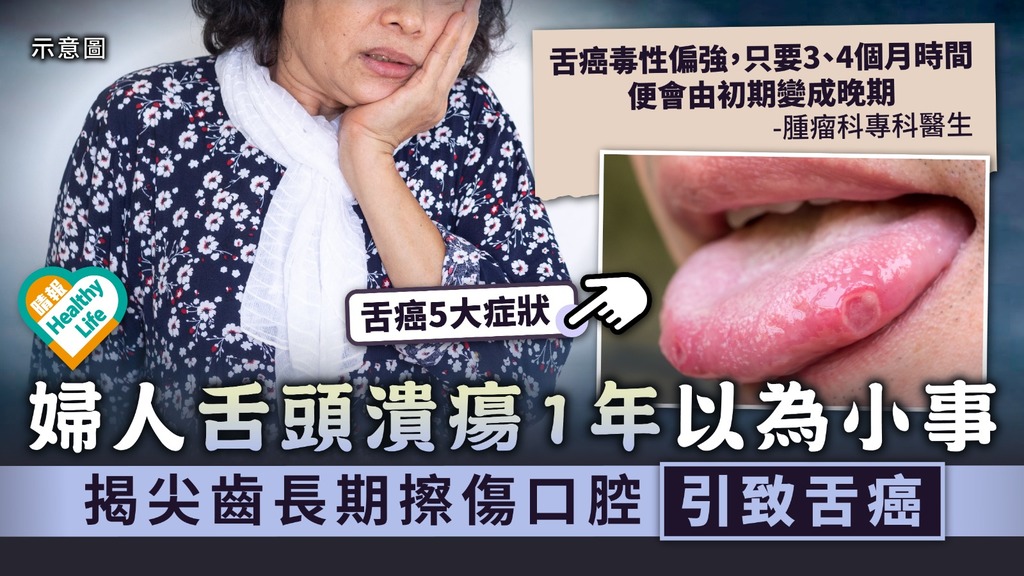 不容忽視︳婦人舌頭潰瘍1年以為小事 揭尖齒長期擦傷口腔引致舌癌︳附舌癌5大症狀