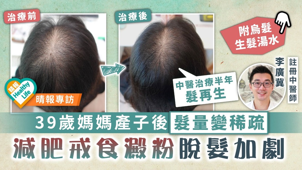 減肥脫髮︳39歲媽媽產子後髮量變稀疏 減肥戒食澱粉脫髮加劇