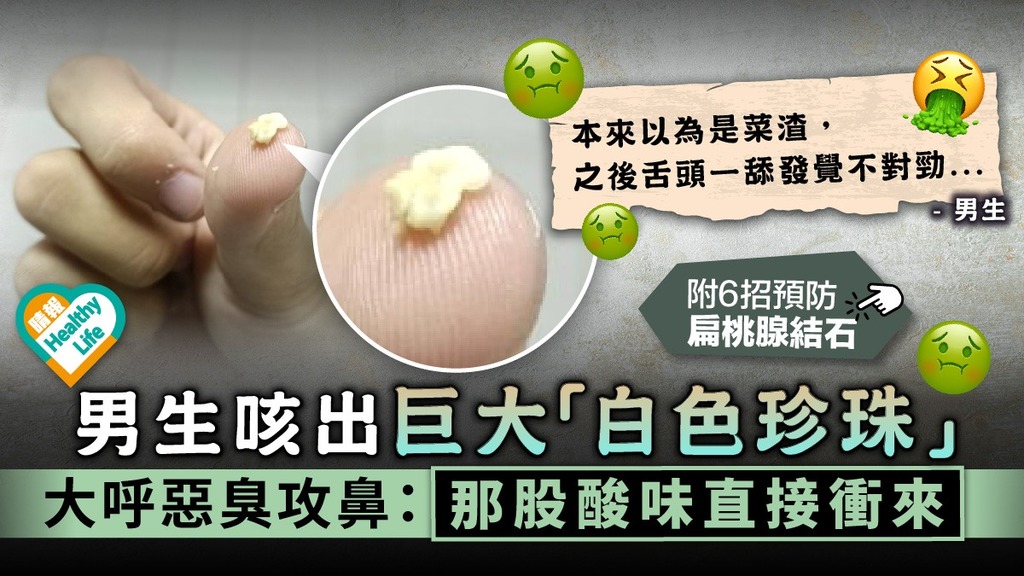 扁桃腺結石︳男生咳出巨大「白色珍珠」 大呼惡臭攻鼻：那股酸味直接衝來︳附6招預防