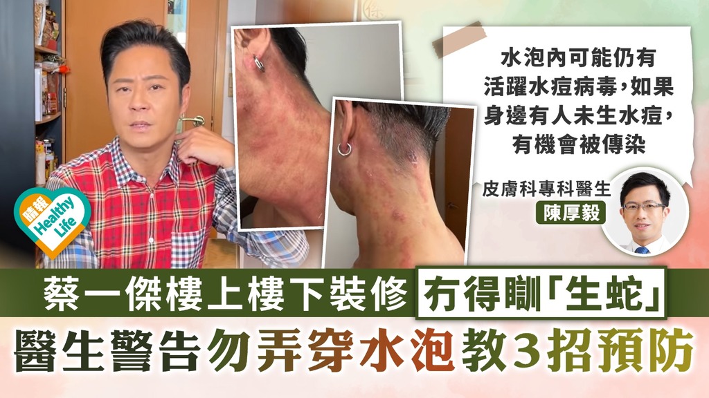 帶狀疱疹︳ 蔡一傑樓上樓下裝修冇得瞓「生蛇」 醫生警告勿弄穿水泡教3招預防