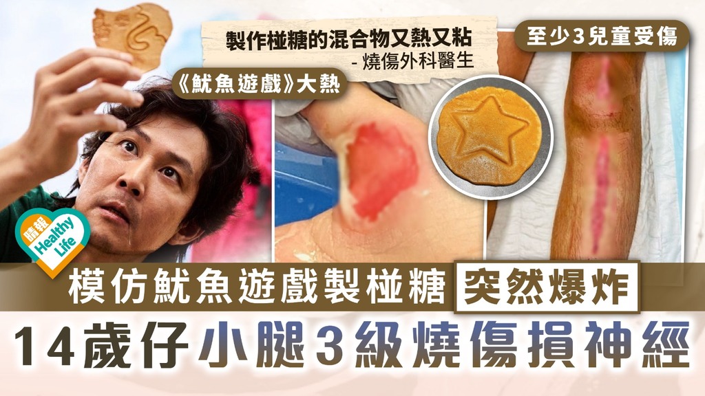 模仿熱潮｜14歲仔模仿魷魚遊戲製椪糖 混合物爆炸小腿3級燒傷損神經｜附4步驟處理燙傷 