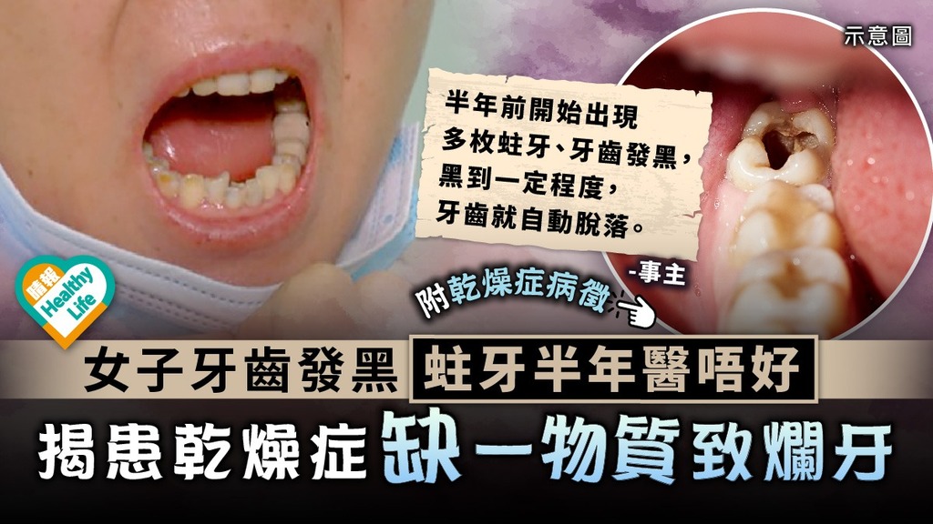 免疫疾病︳女子牙齒發黑蛀牙半年醫唔好 揭患乾燥症缺一物質致爛牙︳附乾燥症病徵